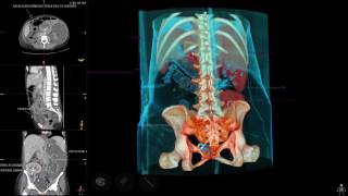 Sectra Table Case Study Kidney Transplant [upl. by Fugate]