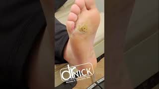 How to treat PLANTAR WARTS shorts [upl. by Ducan]