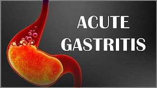 Acute Gastritis  Signs amp Symptoms Causes Pathogenesis Complications Diagnosis amp Treatment [upl. by Cann]