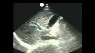 How To Gallbladder Ultrasound Part 1  Introduction Case Study Video [upl. by Alaek]