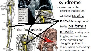 Noninvasive cure of the piriformis syndrome by PNF Copyrights reserved [upl. by Adiehsar]