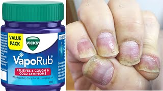 The ultimate solution for Nail Psoriasis Vickss Vaporub revealed [upl. by Eked]