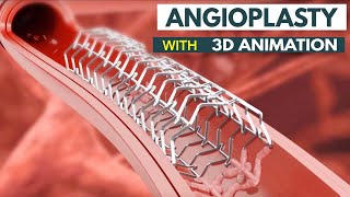 Angioplasty Procedure Explained How It Saves Lives  What Is Angioplasty StepbyStep Explanation [upl. by Eaner4]