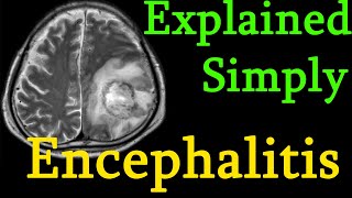 Encephalitis  brain inflammation  Symptoms causes prognosis Treatment explained simply [upl. by Sonny321]