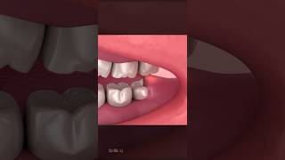 Wisdom Teeth Impaction Explained [upl. by Shiff]