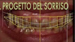 Cambiare laspetto del sorriso con faccette dentali  SMILE DESIGN [upl. by Yemorej]