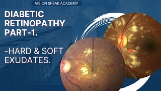 Diabetic Retinopathy 1  Hard amp Soft Exudates [upl. by Clea]