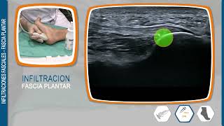 INFILTRACIONES FASCIALES FASCIA PLANTAR [upl. by Aynot]