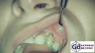 Infiltration anesthesia for treatment tooth 22 [upl. by Fairbanks]