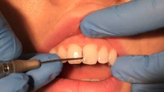 Periodontal Probing [upl. by Temme]