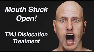 Mouth Stuck Open TMJ Dislocation Treatment Open Lockjaw [upl. by Maon314]