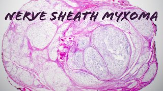 Nerve sheath myxoma with Verocay palisading formerly myxoid neurothekeoma pathology dermpath [upl. by Faun]