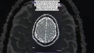 MRI Brain DWI Sequence ADC ImageBrain Pathology mri radiology beginners [upl. by Oiuqise]