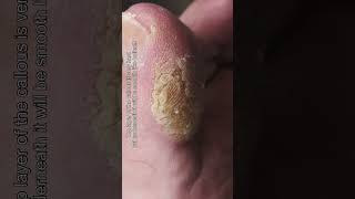 Scraping THICK TOE CALLUS Part 1 callus callusremoval [upl. by Siocnarf]