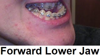 What Happens When Your Lower Jaw Grows Far Forward by Prof John Mew [upl. by Bremer]