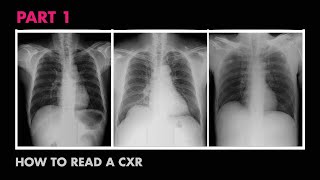 Anatomy of a Chest XRay  How to Read a Chest XRay Part 1 [upl. by Nayt11]