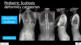 NonAIS Scoliosis Whats the difference [upl. by Icats]