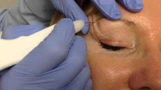 Watch As Dr Dev Patel Walks You Through a Plexr Blepharoplasty Treatment [upl. by Petras]