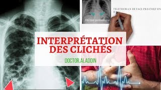 Pneumopathie Interstitielle Diffuse  Maitriser linterprétation des clichés [upl. by Emad]