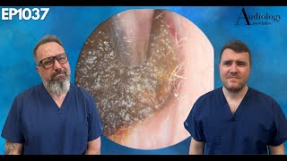 BIG DARK OLD DEEP EAR WAX PLUG REMOVAL  EP1037 [upl. by Schluter]