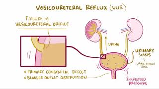 VIDEO Acute pyelonephritis urinary tract infection causes symptoms amp pathology [upl. by Madlin]