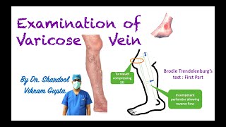 Examination of Varicose Vein for MBBS MS Surgery medical students [upl. by Zicarelli69]