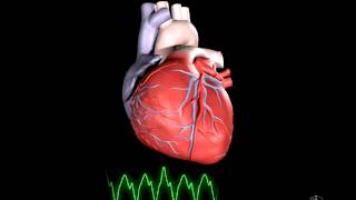 What is Ventricular Tachycardia [upl. by Akemet]