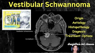 242Vestibular Schwannoma  Acoustic neuroma surgeryeducation [upl. by Aillicirp70]