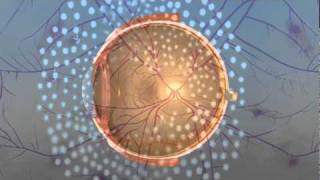 Vitrectomy Surgery for Diabetic Retinopathy [upl. by Sitof599]