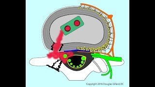 Fusion with BMP Lets discuss the pros and cons of rhBMP2 as used in lumbar fusion [upl. by Annekahs142]