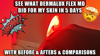 SEE WHAT DERMALUX FLEX MD DID FOR MY SKIN IN 5 DAYS  W BEFORE amp AFTERS DEMO amp COMPARISONS [upl. by Eirrehs]