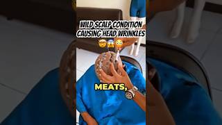 Extra Scalp Skin🥩😫🤮 Wrinkly Heads CVG Explained with Laughs😅 [upl. by Nicole]