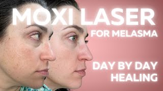 MOXI LASER FOR MELASMA DAY BY DAY HEALING [upl. by Schroder]