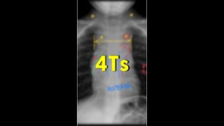 4Ts do mediastino anterior [upl. by Nosac989]