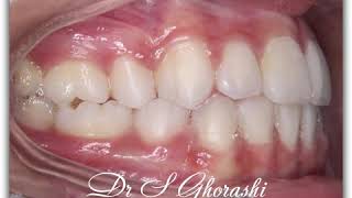 16bimaxillary protrusion  Drghorashi [upl. by Grissom]