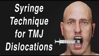 Syringe Method to SelfReduce TMJ Jaw Dislocation Open Lockjaw [upl. by Oivat472]