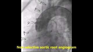 Sequential graft in coronary artery bypass graft surgery [upl. by Rehotsirk]