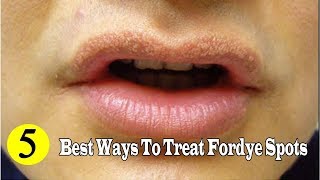 5 Best Ways to Remove Fordyce Spots Naturally at Home YouTube [upl. by Darnoc217]