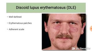 Discoid Lupus Erythematosus DLE [upl. by Bartlett]