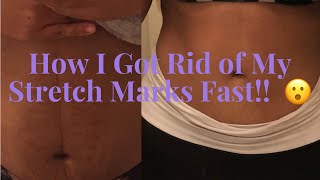 How I got rid of my stretch marks fast [upl. by Boleyn]