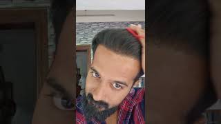 Hair Transplantation Results After 4 Months LaDensitae Hairtransplantation Results Kerala [upl. by Rot308]