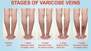 Stages of Varicose Veins [upl. by Dole]