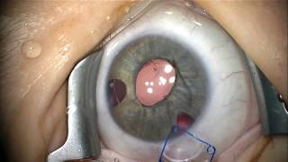 a complicated congenital glaucoma case [upl. by Auhsuj]