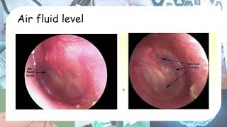 Acute otitis media  Otoscopy findings [upl. by Walcott]