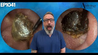 The Most Shocking Ear Wax Removal Youve Never Seen  EP1041 [upl. by Nielson]