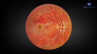 Central Retinal Vein Occlusion CRVO Medication Injection amp Laser Treatment  Free Eye Patient App [upl. by Cloe914]