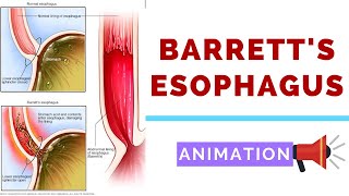 Barretts Esophagus  Pathology Dysplasia and Carcinoma [upl. by Attey]