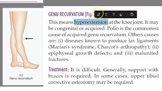 Orthopedics 344 genu recurvatum Polio hyperextension of knee joint [upl. by Castara]