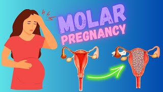 Molar pregnancy  Hydatiform Mole Risk Factors Types Symptoms Diagnosis And Treatment GTD [upl. by Arihsa533]