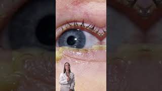 CONJUNTIVITIS BACTERIANA saludocular cuidadodelosojos doctora [upl. by Nosyd]